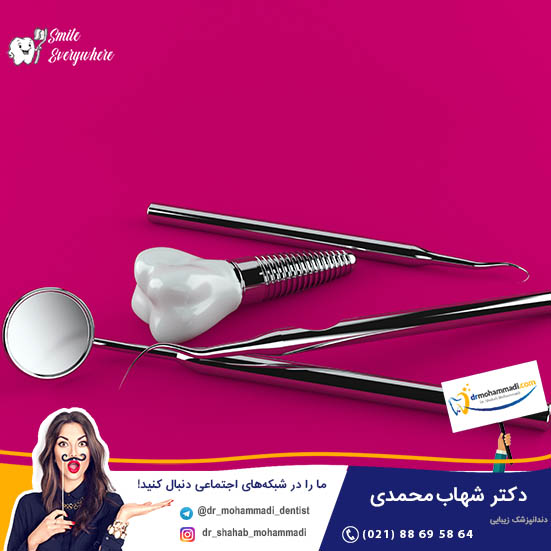 آمارهای ایمپلنت دندان: درصد موفقیت و شکست کاشت ایمپلنت - کلینیک دندانپزشکی دکتر شهاب محمدی