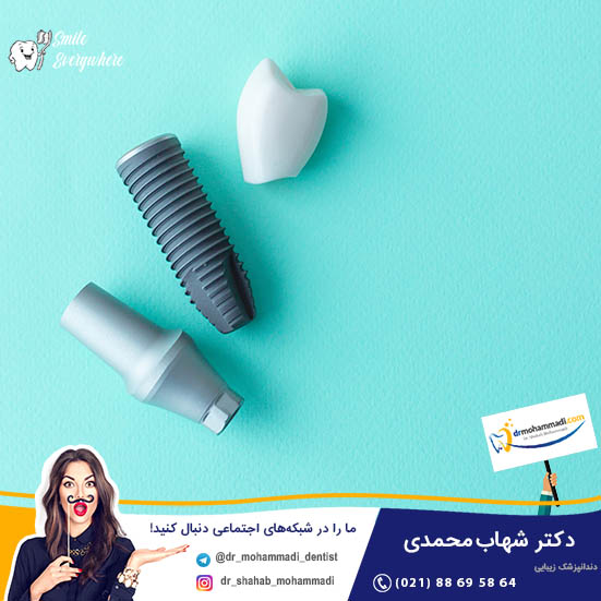 مراحل کاشت ایمپلنت دندان - کلینیک دندانپزشکی دکتر شهاب محمدی