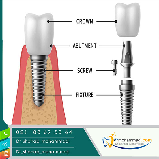 اجزای ایمپلنت دندان چیست و از چه چیزی ساخته شده است؟ - کلینیک دندانپزشکی دکتر شهاب محمدی