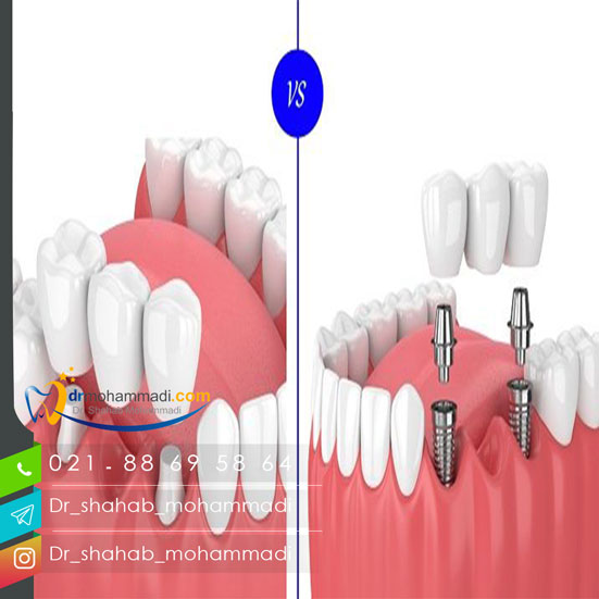 بریج و ایمپلنت چه تفاوت هایی با هم دارند
