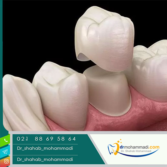 تاج دندان چیست و انواع تاج و روش های مراقبت آن کدامند؟ - کلینیک دندانپزشکی دکتر شهاب محمدی