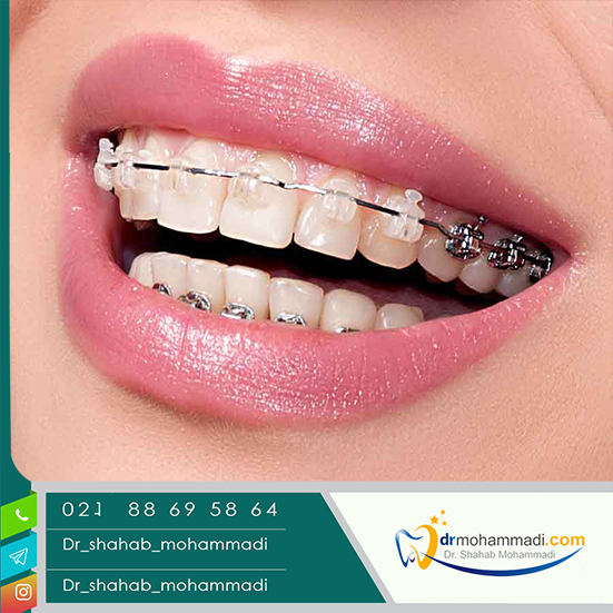 ارتودنسی بهتر است یا لمینت دندان؟ - کلینیک دندانپزشکی دکتر شهاب محمدی