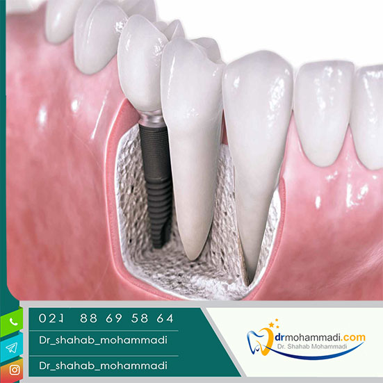 علت تفاوت قیمت در ایمپلنت دندان