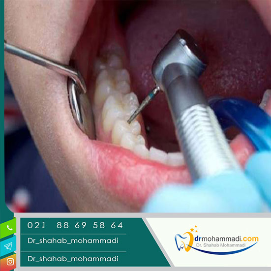 علت درد دندان بعد از عصب کشی و درمان آن چیست؟