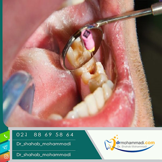 درمان ریشه دندان چه مزایایی دارد؟
