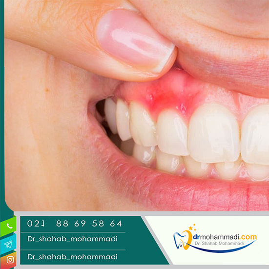 علائم و درمان کیست دندان