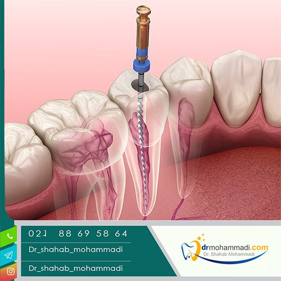 آیا ریشه دندان قابل ترمیم است؟