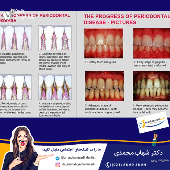 پریودنتیت چیست و چرا رخ می دهد؟