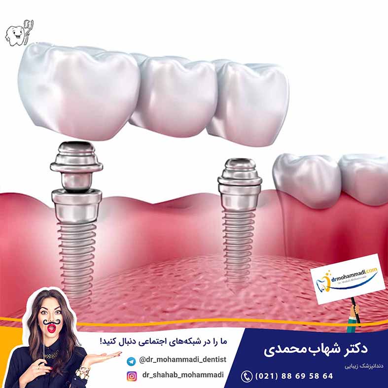 بریج برپایه ایمپلنت - کلینیک دندانپزشکی دکتر شهاب محمدی