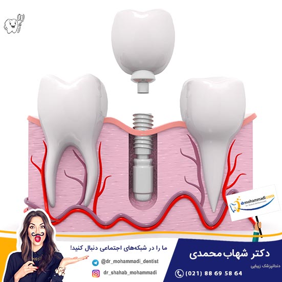 آماده سازی بستر ایمپلنت پیش از خارج کردن interradicular - کلینیک دندانپزشکی دکتر شهاب محمدی