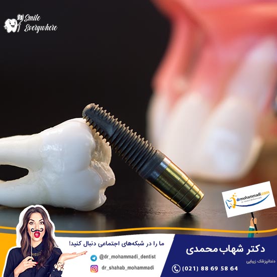 آیا استفاده از ایمپلنت چینی عوارض دارد؟ - کلینیک دندانپزشکی دکتر شهاب محمدی