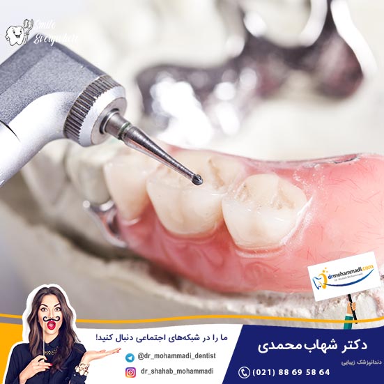 آیا می توان دندان مصنوعی متحرک را با ایمپلنت دندان جایگزین کرد؟ - کلینیک دندانپزشکی دکتر شهاب محمدی