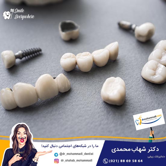 ایمپلنت دندان جایگزینی مطمئن برای بریج دندان سنتی - کلینیک دندانپزشکی دکتر شهاب محمدی