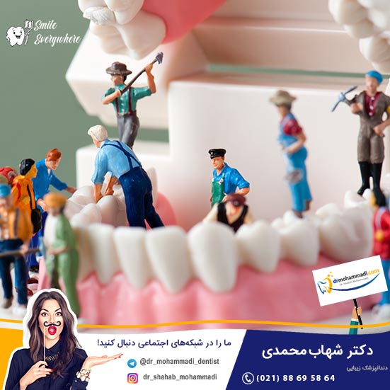 بهترین روش اصلاح و ترمیم دندان ها کدام است: ونیر دندان یا کاشت ایمپلنت - کلینیک دندانپزشکی دکتر شهاب محمدی