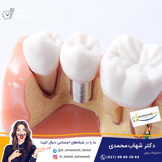 آیا  پروتز دندان مصنوعی بر پایه ایمپلنت را نیز باید از دهان خارج کرد؟ - کلینیک دندانپزشکی دکتر شهاب محمدی
