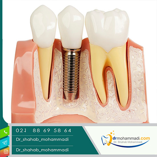 معرفی بهترین مرکز ایمپلنت دندان در تهران