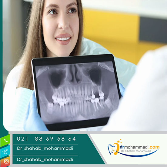 ایمپلنت دندان دیجیتال چیست؟ 