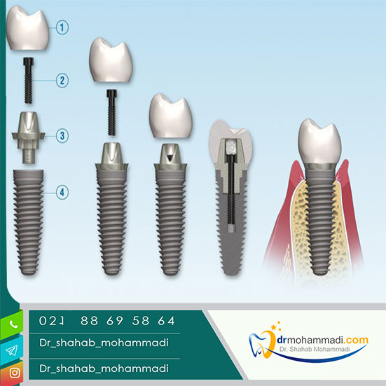 اجزای ایمپلنت دندان