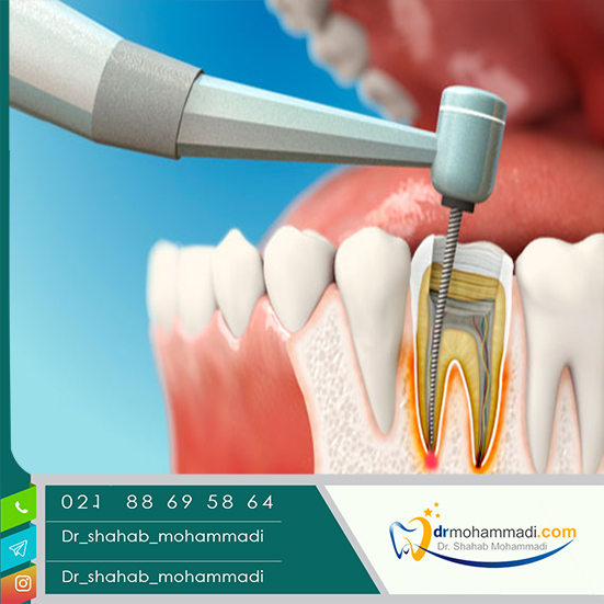 وقتی دندان سوراخ و به عصب رسیده چه کنیم؟