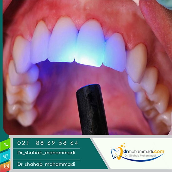 آنتی بیوتیک برای عفونت سقف دهان