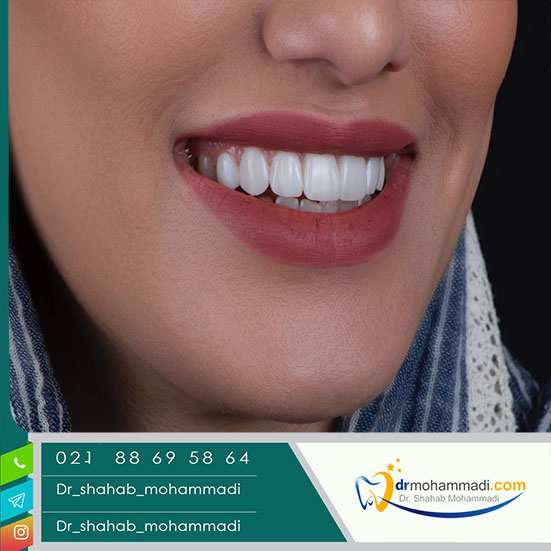 آیا روکش دندان با کامپوزیت فرق دارد؟