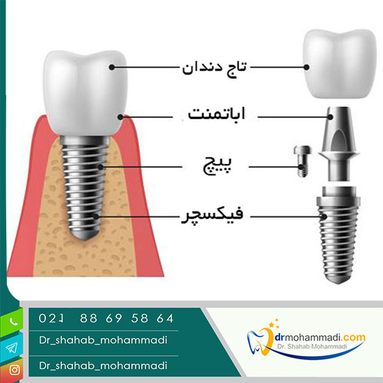 اجزای ایمپلنت