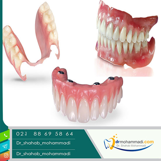 پروتز دندان یا دندان مصنوعی چیست؟