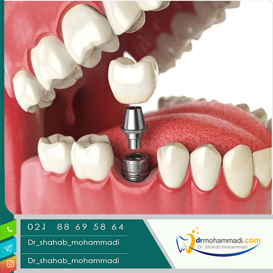 قیمت ایمپلنت دندان