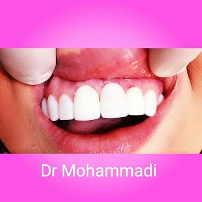 ونیر طرح لبخند