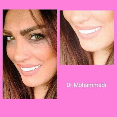 ونیر طرح لبخند