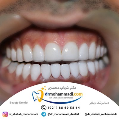 لمینیت طرح لبخند