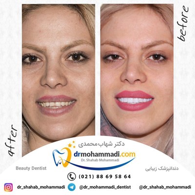 ونیر کامپوزیت طرح لبخند بدون تراش