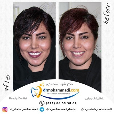 کامپوزیت ونیر طرح لبخند بدون تراش