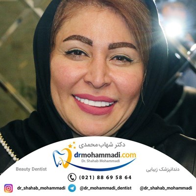 کامپوزیت ونیر طرح لبخند بدون تراش