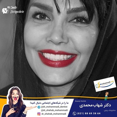 کامپوزیت ونیر طرح لبخند بدون تراش