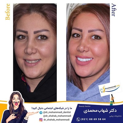 کامپوزیت ونیر طرح لبخند بدون تراش