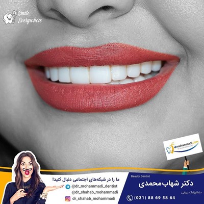 کامپوزیت ونیر طرح لبخند بدون تراش