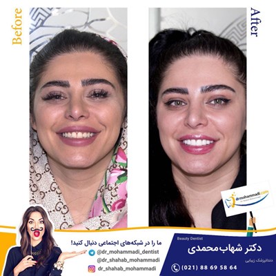 لمینیت طرح لبخند