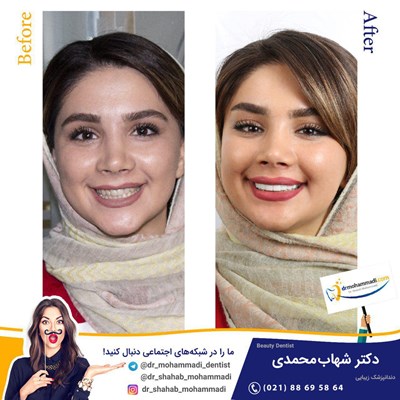 کامپوزیت ونیر طرح لبخند بدون تراش