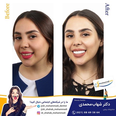 کامپوزیت ونیر طرح لبخند بدون تراش