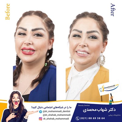 کامپوزیت ونیر طرح لبخند بدون تراش