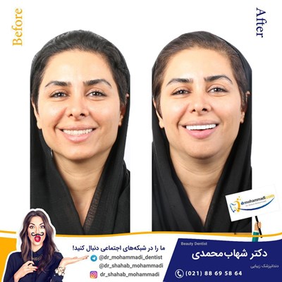کامپوزیت ونیر طرح لبخند بدون تراش