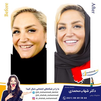 کامپوزیت ونیر طرح لبخند بدون تراش