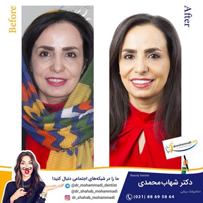 کامپوزیت طرح لبخند بدون تراش