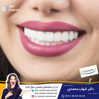 کامپوزیت ونیر طرح لبخند بدون تراش
