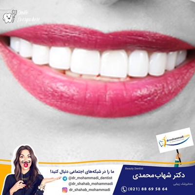 کامپوزیت ونیر طرح لبخند بدون تراش