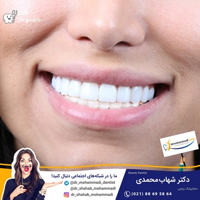کامپوزیت ونیر طرح لبخند بدون تراش