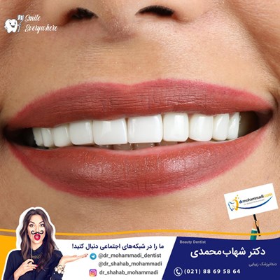 کامپوزیت ونیر طرح لبخند بدون تراش