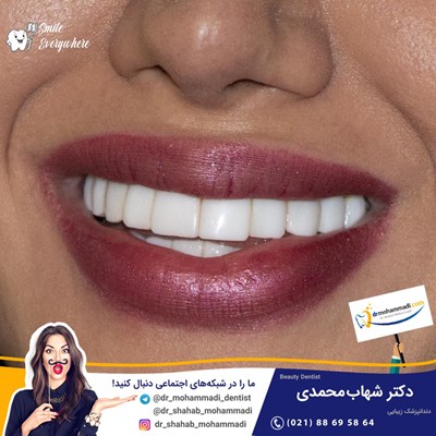 کامپوزیت ونیر طرح لبخند بدون تراش