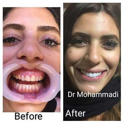 ونیر طرح لبخند